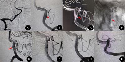 Flow diversion effect of the leo braided stent for aneurysms in the posterior and distal anterior circulations: A multicenter cohort study